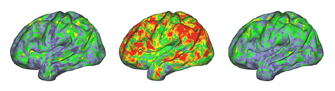 brain scan psilocybin